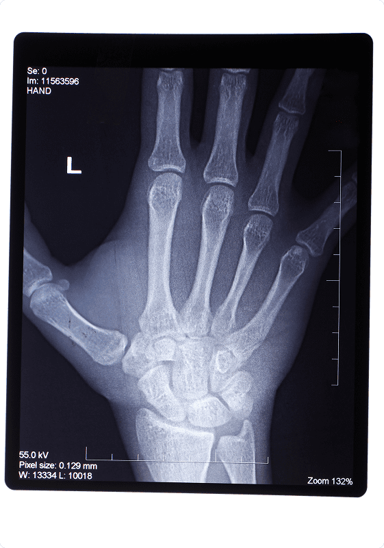 Basal Joint Arthritis