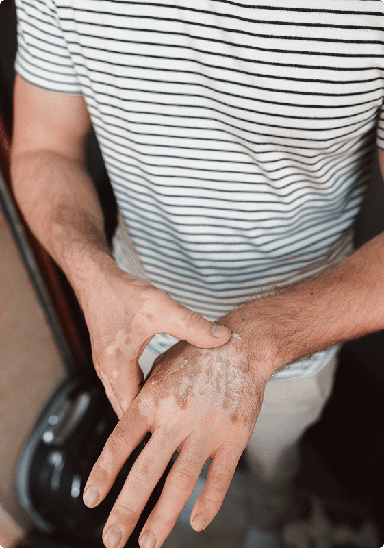 De Quervain's Tendonosis